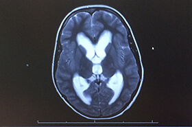 Kaiden's MRI showing fluid build up