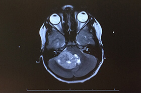 Kaiden MRI showing lemon sized tumour